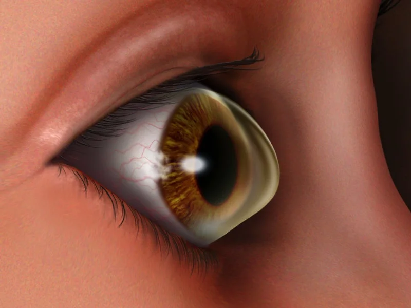 Keratoconus
