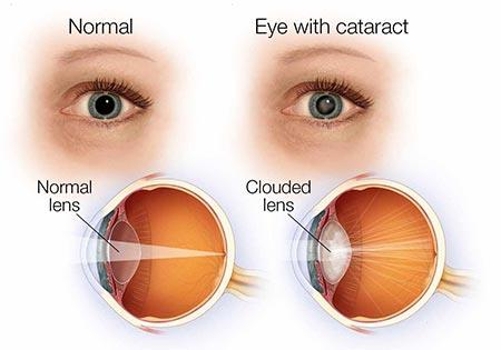 Diagnosis Investigation and Treatment of Congenital Cataract