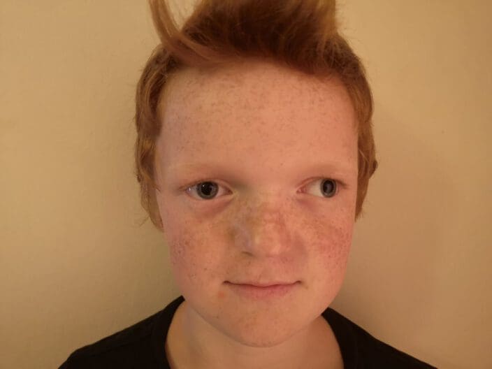 Exotropia