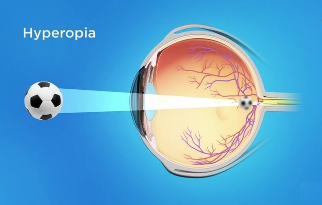 Hyperopia: Clinical Presentation and Management
