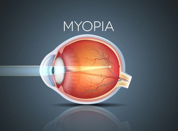 Myopia: Clinical Presentation and Management