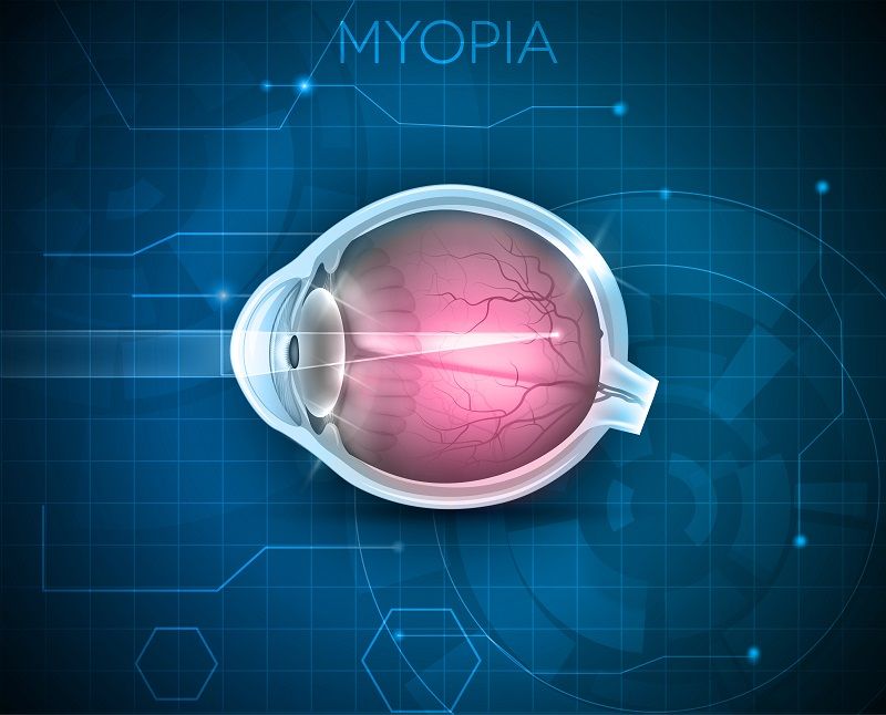 Myopia Control: A Comprehensive Clinical Guide