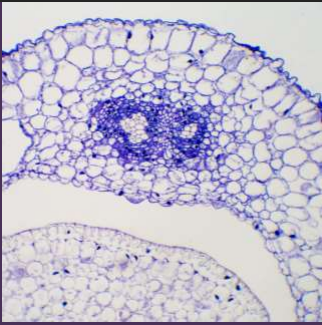 Retinitis pigmentosa(RP)