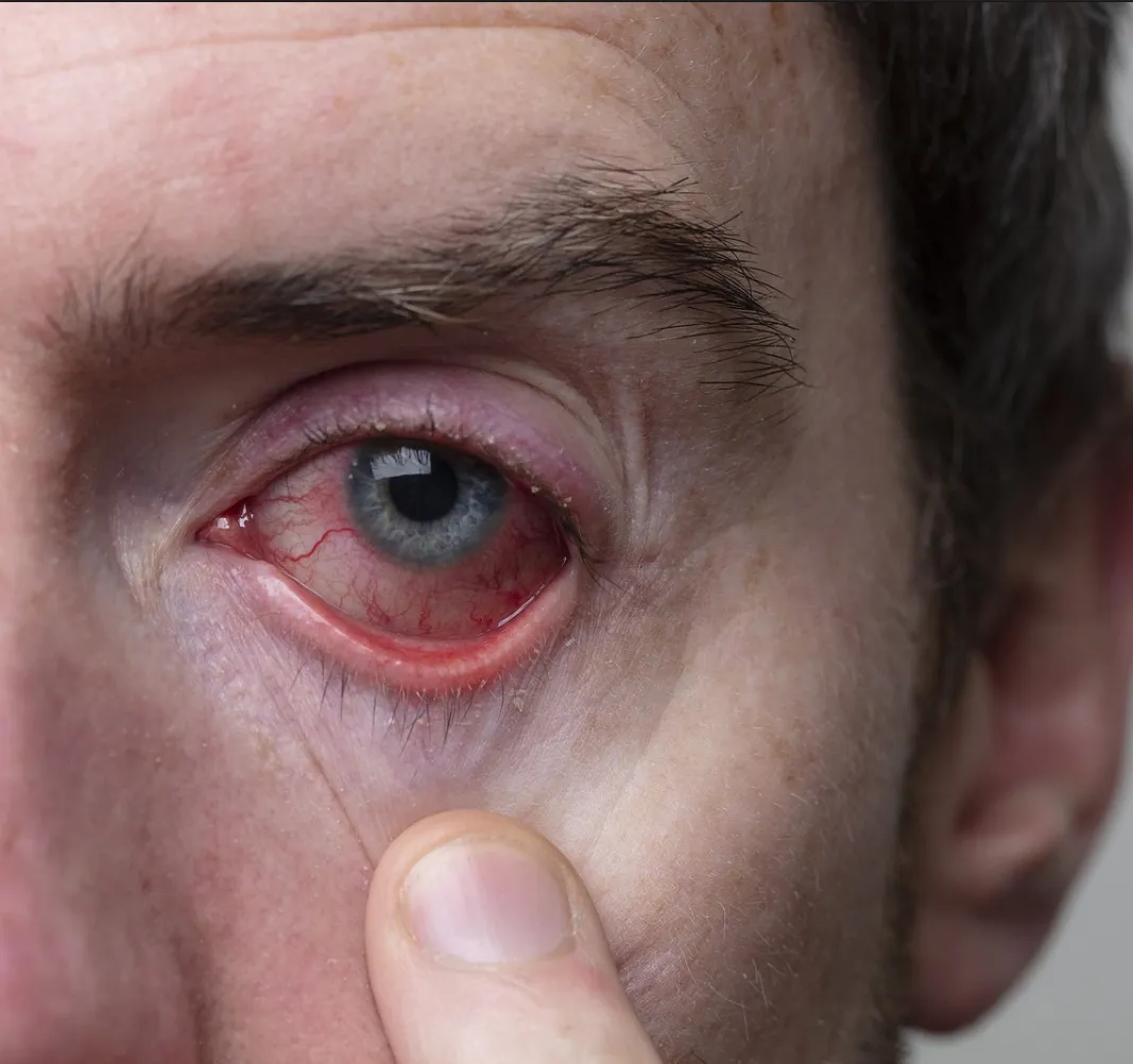 Anterior Uveitis